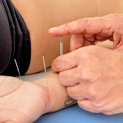 fisioterapeuta-marcia-domingos-atendimento-acupuntura-barra-tijuca Fisioterapeuta aplicando Acupuntura em paciente no consultório da Barra da Tijuca
