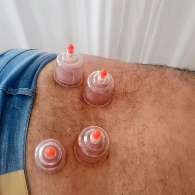Tratamento ventosaterapia na Barra da Tijuca